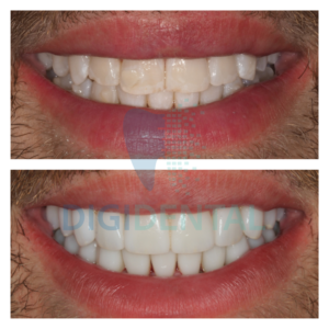 Clear Aligners Treatment