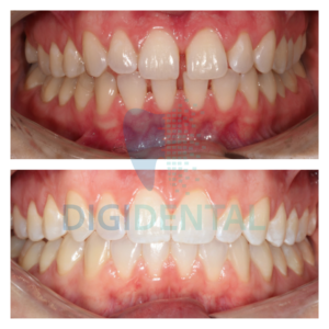 Invisalign Clear Braces