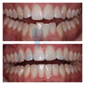 invisalign aligners