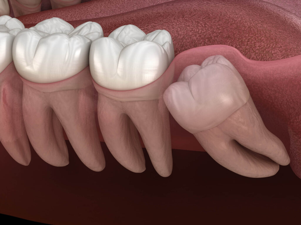 wisdom teeth surgery