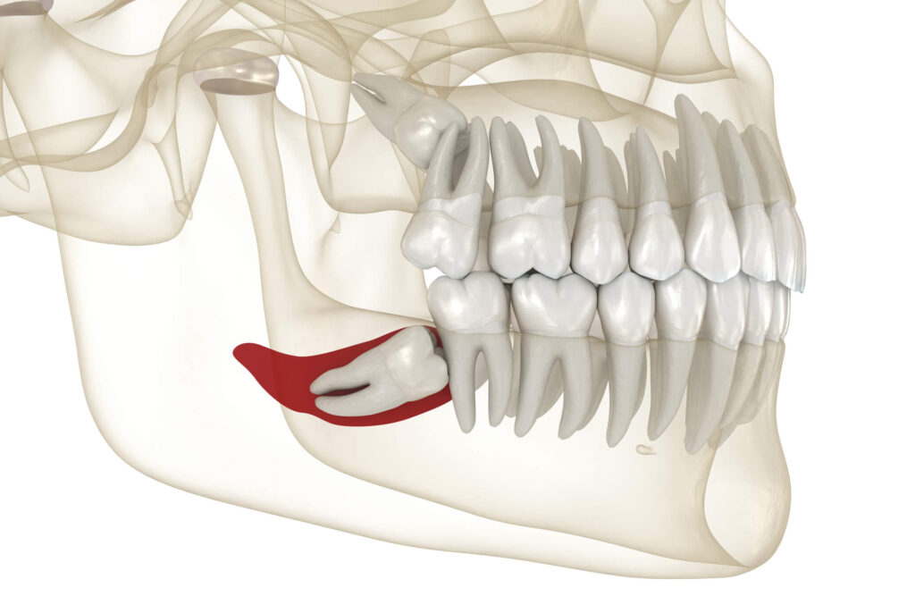 Wisdom Tooth Removal Aartamon