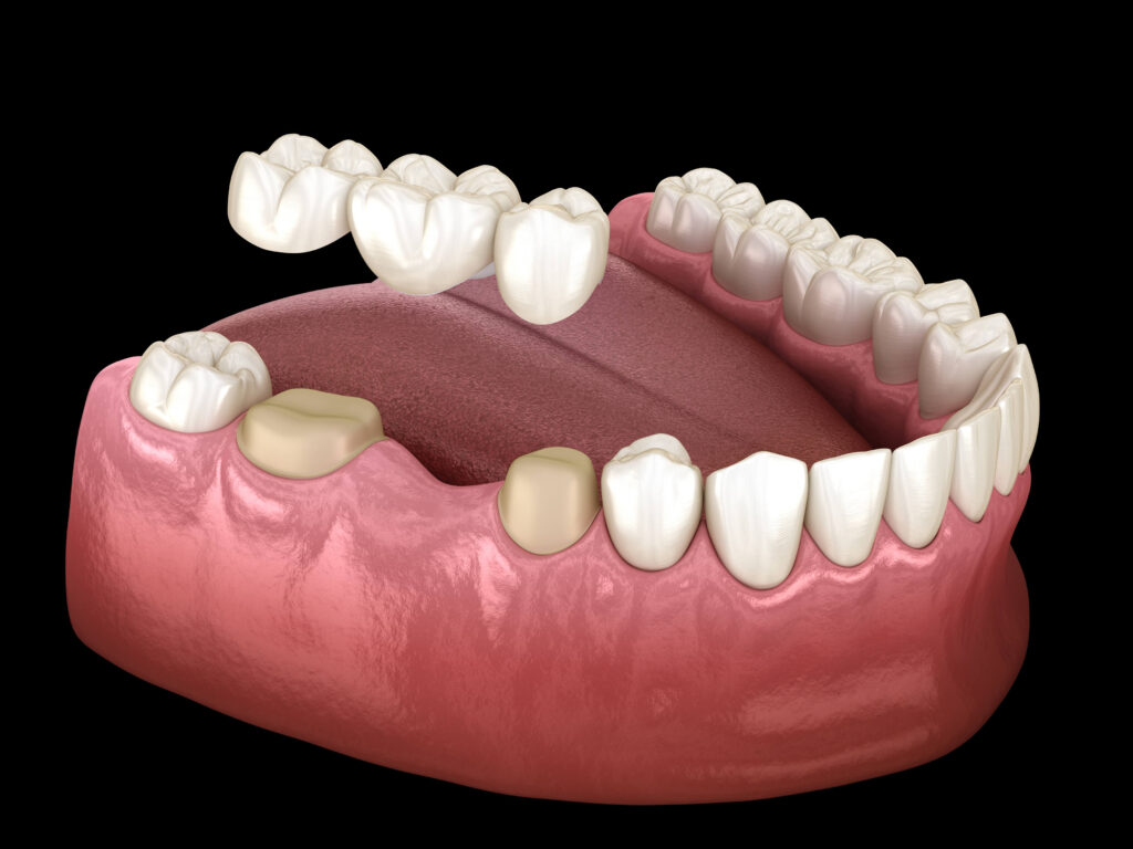 dental implant bridge